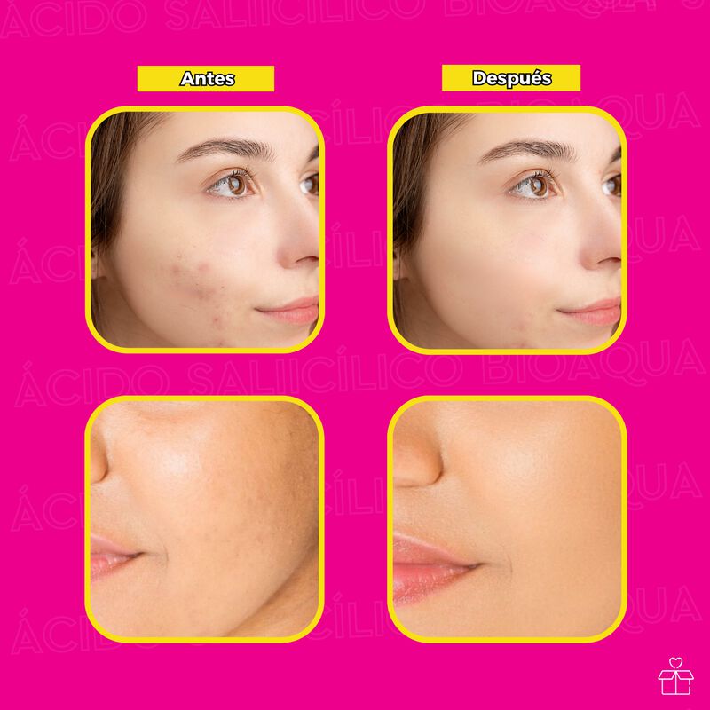 Crema de Ácido Salicílico Anti Acné Reduce Gras... image number null