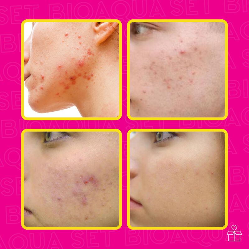 Set de 3 Pure Skin Bioaqua Retira Acn&eacute; Espinill... image number null
